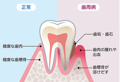 正常な歯肉と歯周病の比較