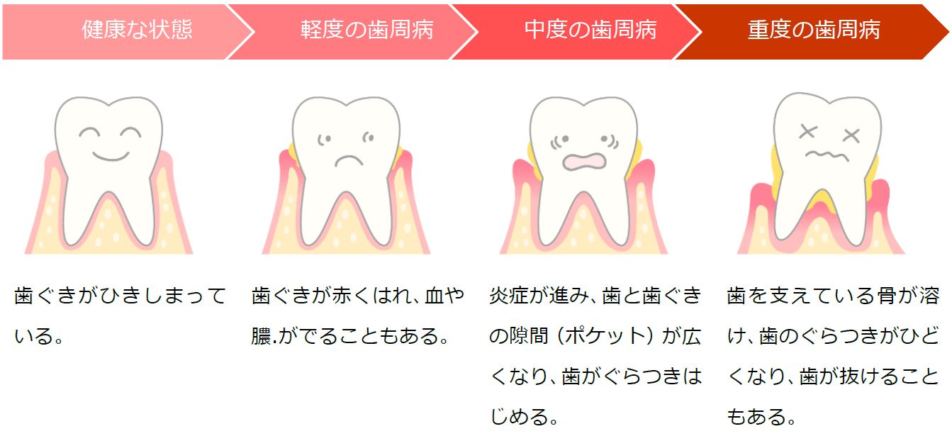 歯肉炎・歯周炎・歯槽膿漏の違い | 瓢箪山の歯医者|医療法人小川歯科医院|東大阪市