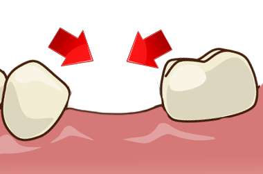 隣接歯の傾斜