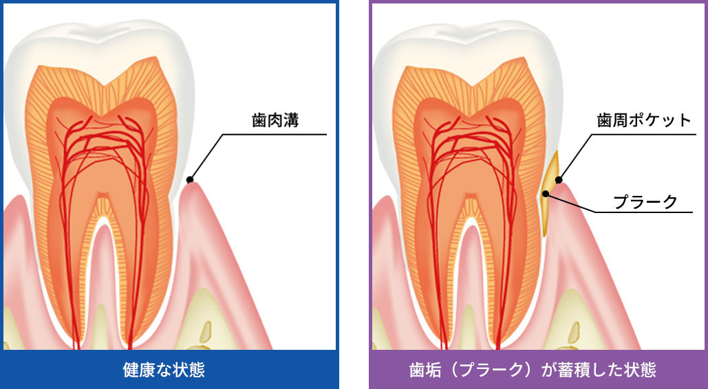 歯肉溝と歯周ポケット
