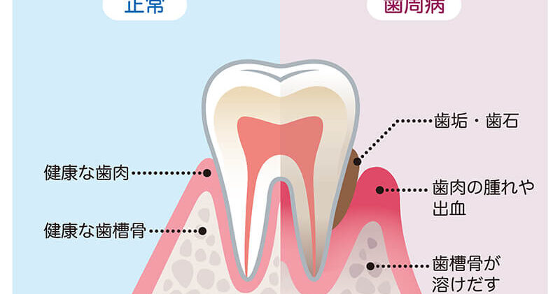歯周病