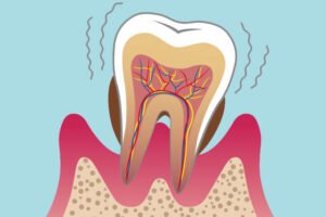 歯周病の悪化