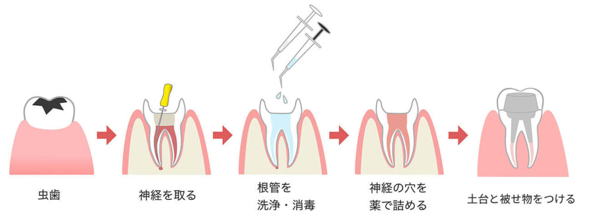 虫歯治療の流れ