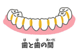 磨き残し：歯と歯の間