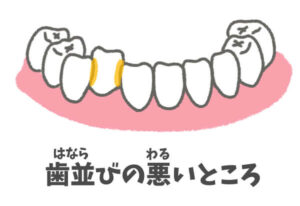 磨き残し：歯並びの悪いところ