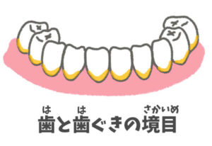 磨き残し：歯と歯茎の境目