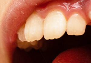 切縁結節(マメロン)