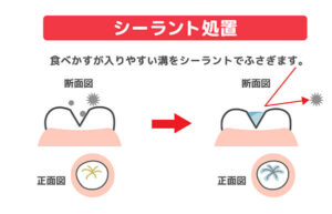 シーラント